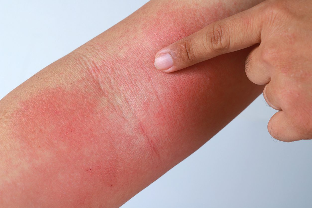 14 Soothing Home Remedies for Sunburn